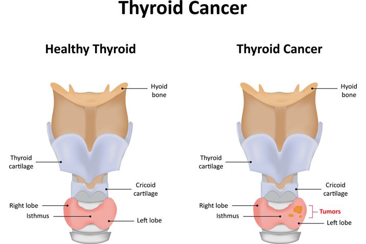 THYROID CANCER